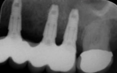 Implants Implants